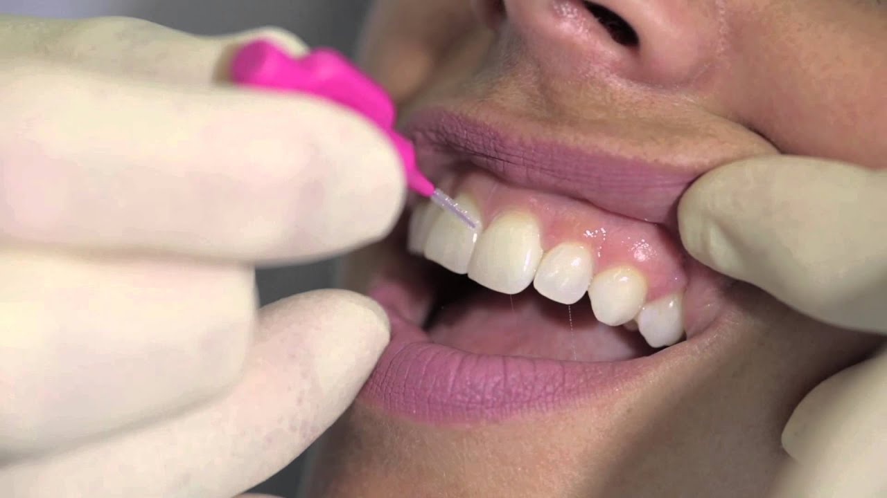 Are Interdental Brushes Safe for Sensitive Gums and